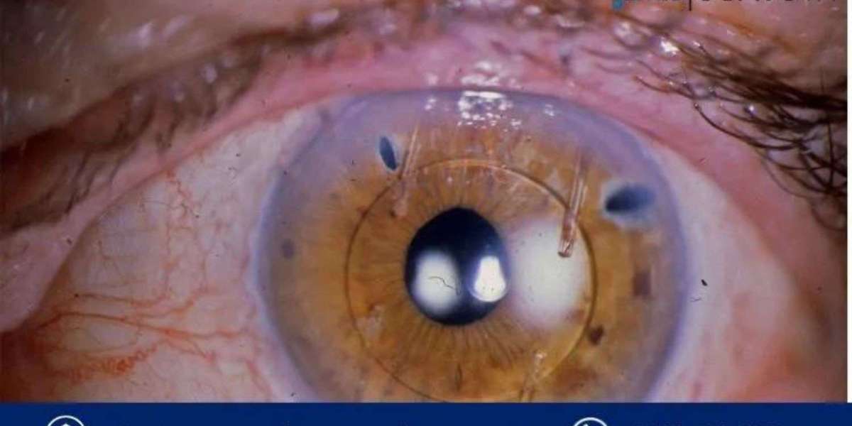 Ocular Implants Market Share, Trend, Report, Size & Outlook | 2034